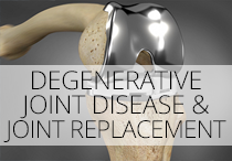 Joint Replacement